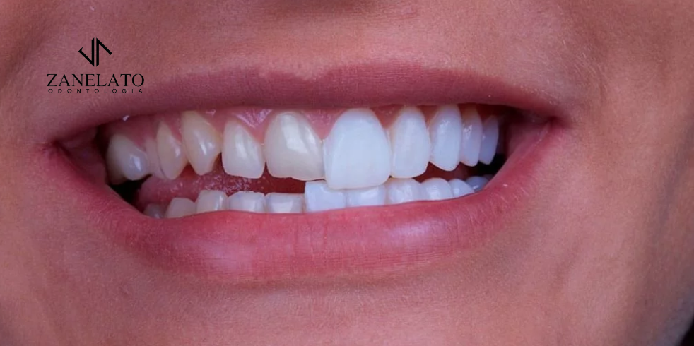 Fraturas nos Dentes: Como Recuperar?
