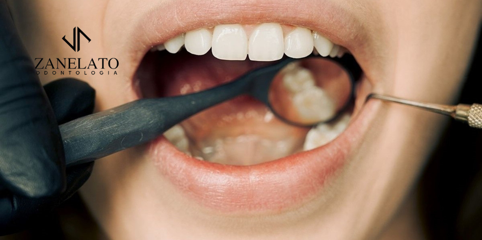 Implantes Dentários: Quais os Procedimentos Necessários?
