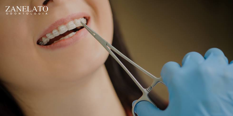 Benefícios e Indicações das Lentes de Contato Dental
