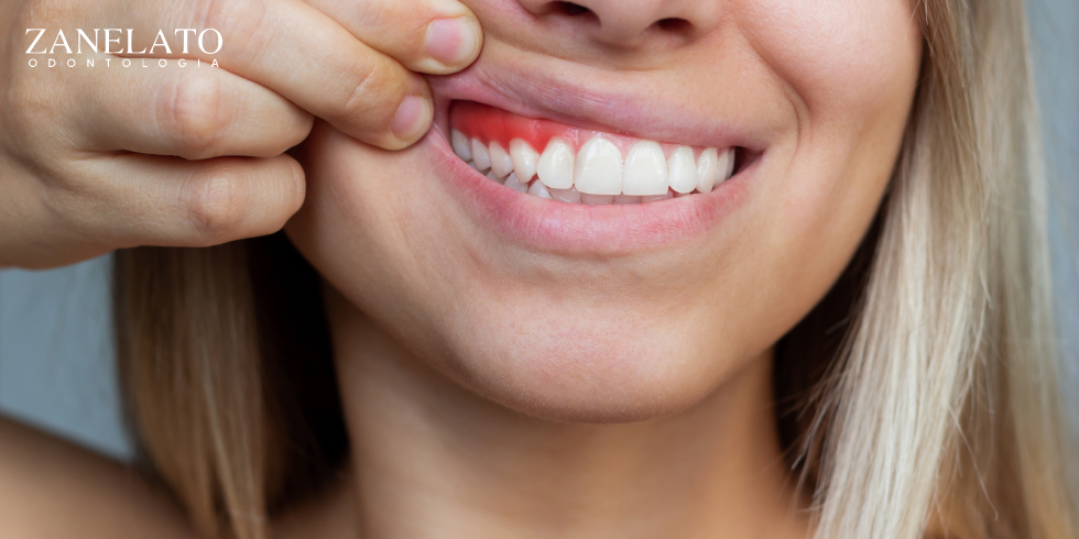 Lentes de Contato: Como o Procedimento Recupera os Dentes Danificados
